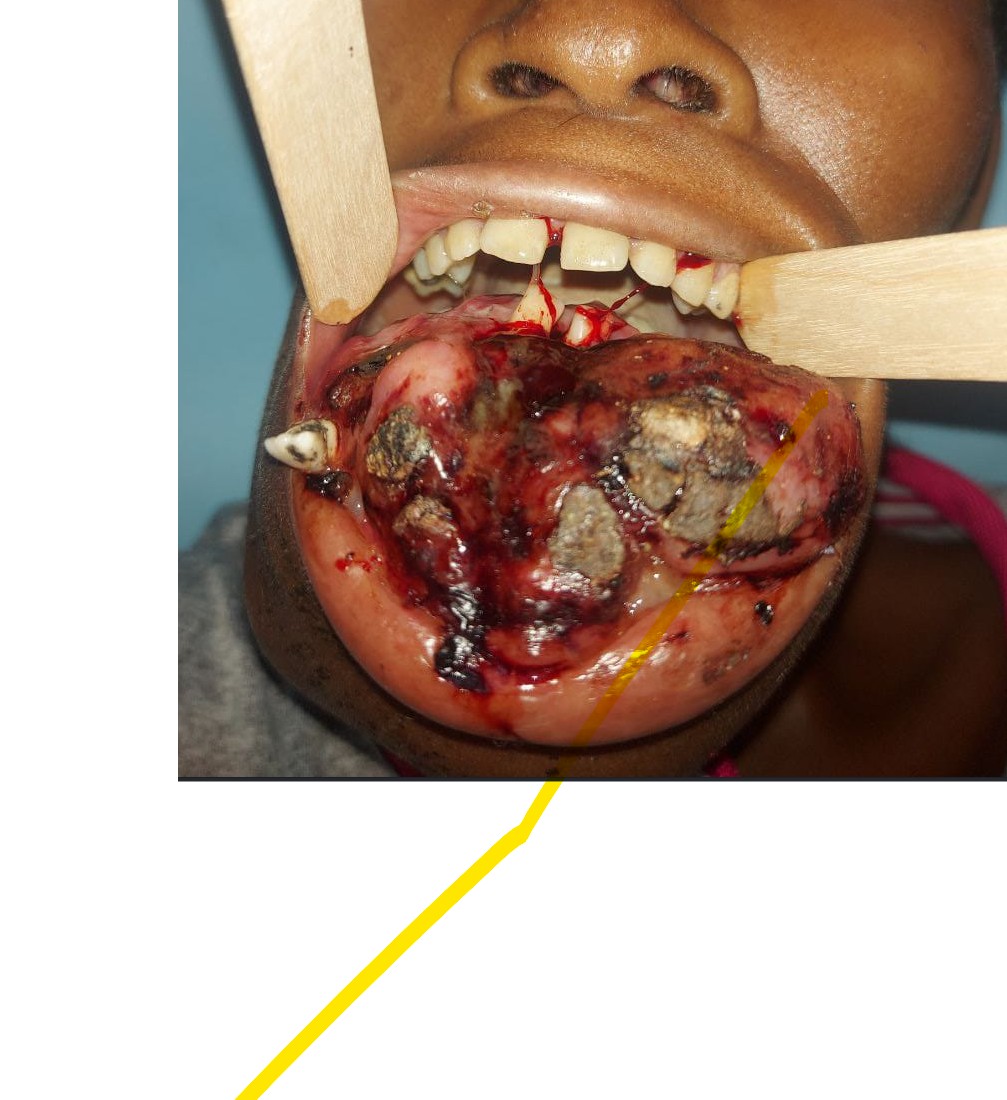 Cancer cavité orale