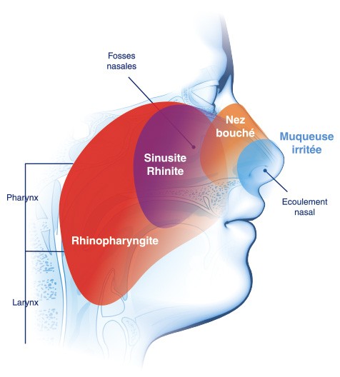 Pathologies infectieuses ORL